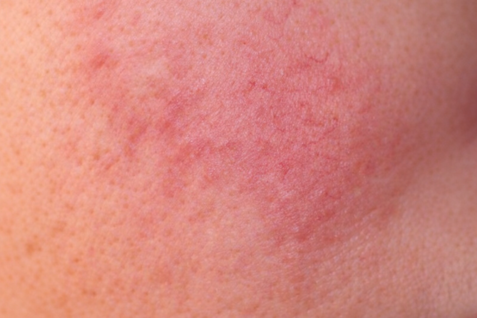 Rosacea