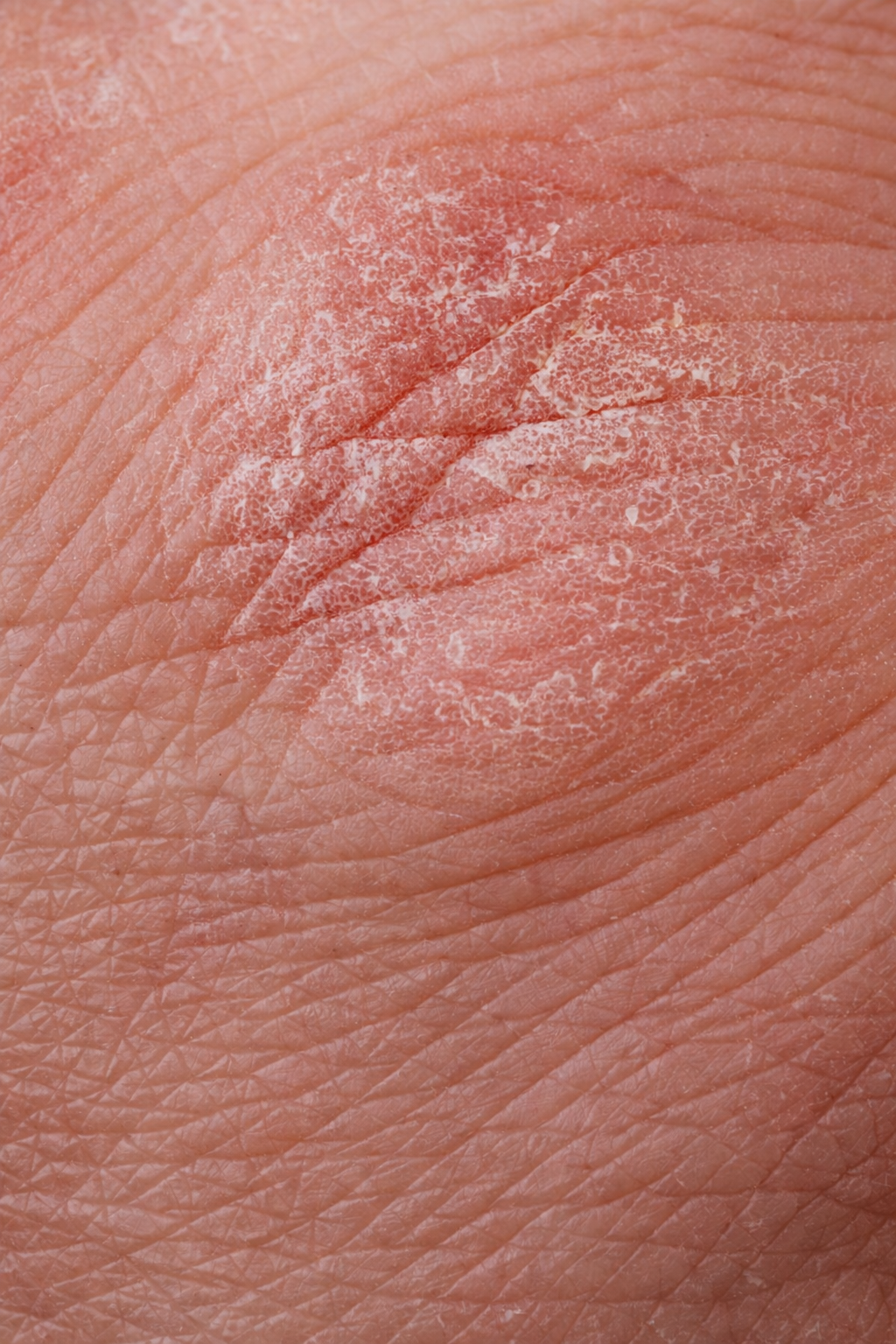 Tør hud er en tilstand, hvor huden mangler fugt og/eller fedt